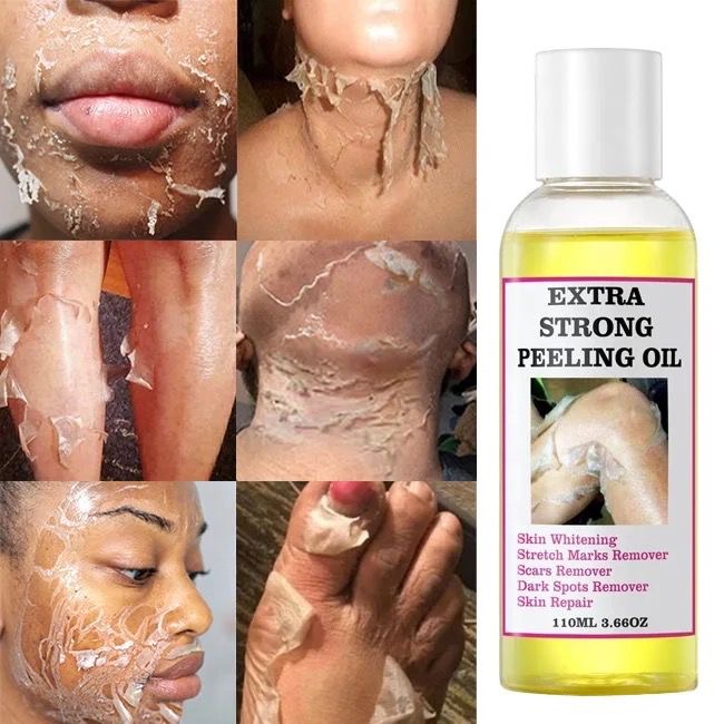 Extra strong peeling Very effective Good for stretch marks.